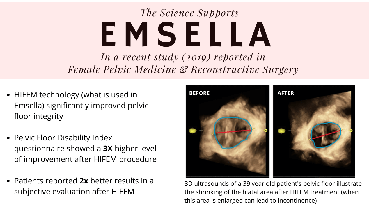 HIFEM Study Results